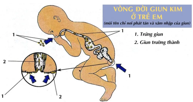 Giun kim xuất hiện ở bộ phận sinh dục nữ